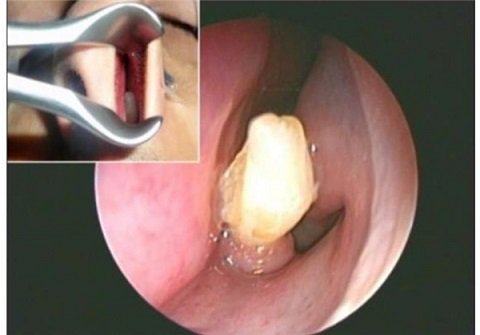 پسر 22 ساله که در بینی اش دندان دارد! (+عکس)
