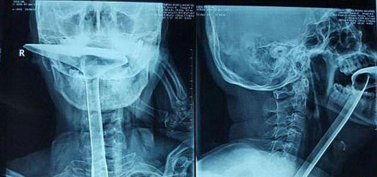 زنی که کفگیر آشپزخانه را بلعید! (+عکس)