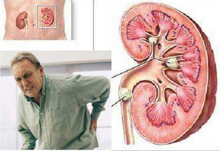 نوع آب آشامیدنی ارتباط چندانی با سنگ کلیه ندارد