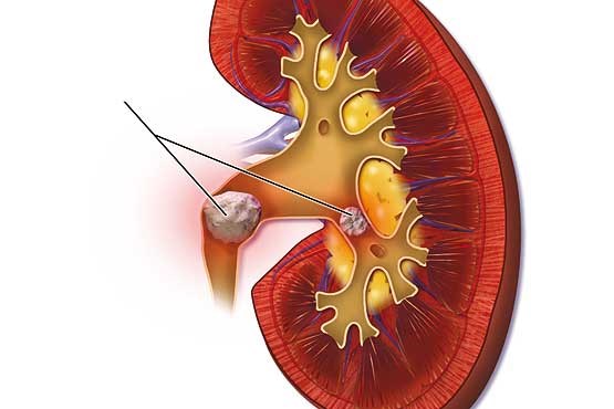امید تازه برای پیشگیری از ایجاد سنگ های کلیه