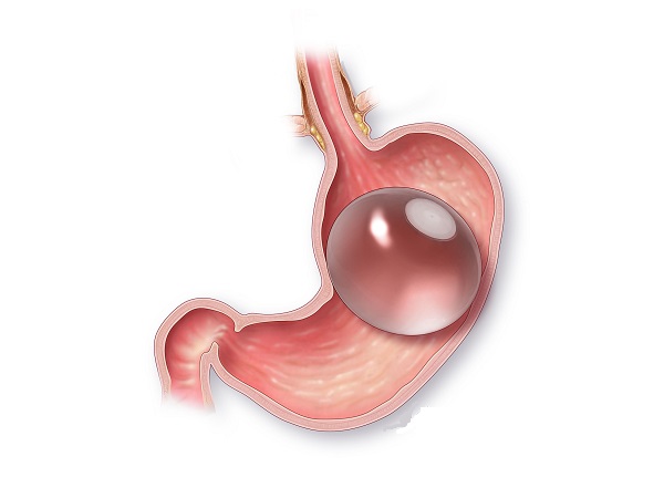 آیا بالونهای معده آینده کاهش وزن هستند؟ آیا بالونهای معده آینده کاهش وزن هستند؟