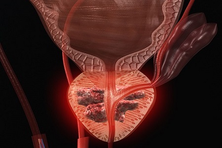 کلینیک سرطان عصر ایران
