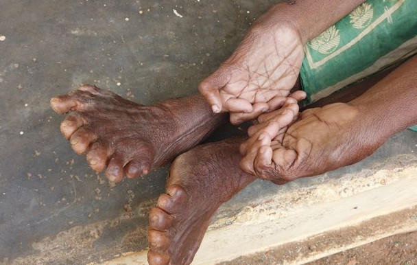 زنی که دارای رکورد بیشترین انگشت دست و پا است! (+عکس) بیشترین انگشت دست و پا