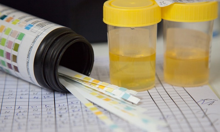 آلبومینوریا؛ وقتی پروتئین در ادرار نشت میکند آلبومینوریا؛ وقتی پروتئین در ادرار نشت میکند