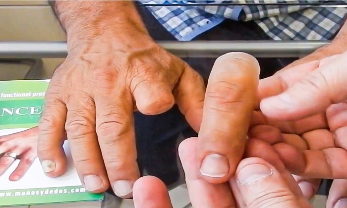 پروتزهایی که زندگی انسانها را تغییر میدهند پروتزهایی که زندگی انسانها را تغییر میدهند