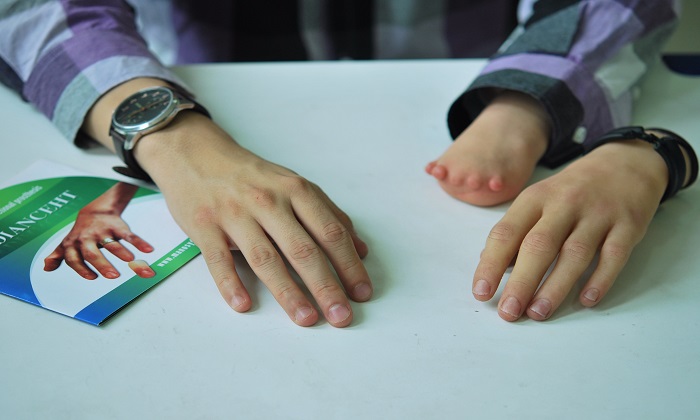 پروتزهایی که زندگی انسانها را تغییر میدهند پروتزهایی که زندگی انسانها را تغییر میدهند