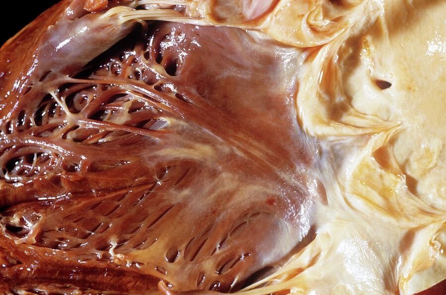 از قلبی که با چربی پوشیده شده تا تهدید سلامت انسان