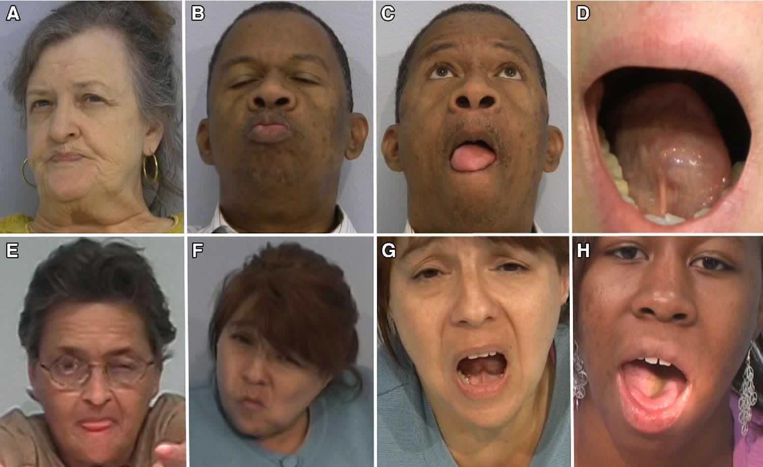 بیماری دیسکینزی چیست؟ حرکات غیر ارادی بدن