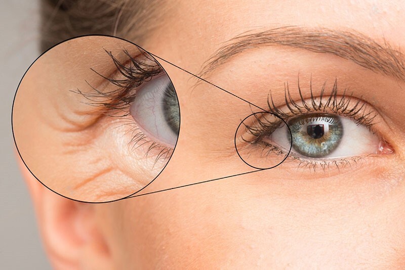 همه چیز در مورد چین و چروک دور چشم